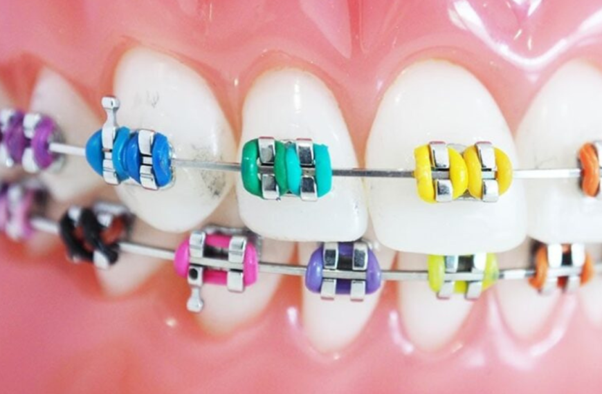braces color selector